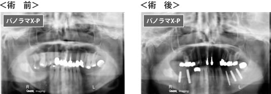 パノラマX-P インプラント手術前後