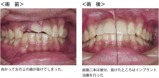 症例2の手術前・後