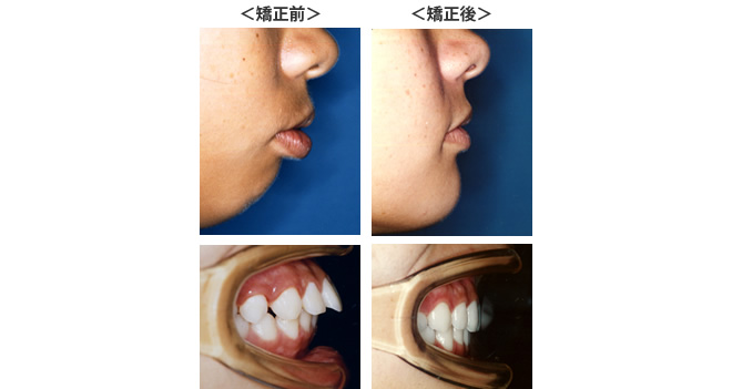 矯正治療の症例