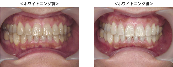 ホワイトニング前・後